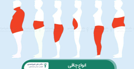 انواع چاقی